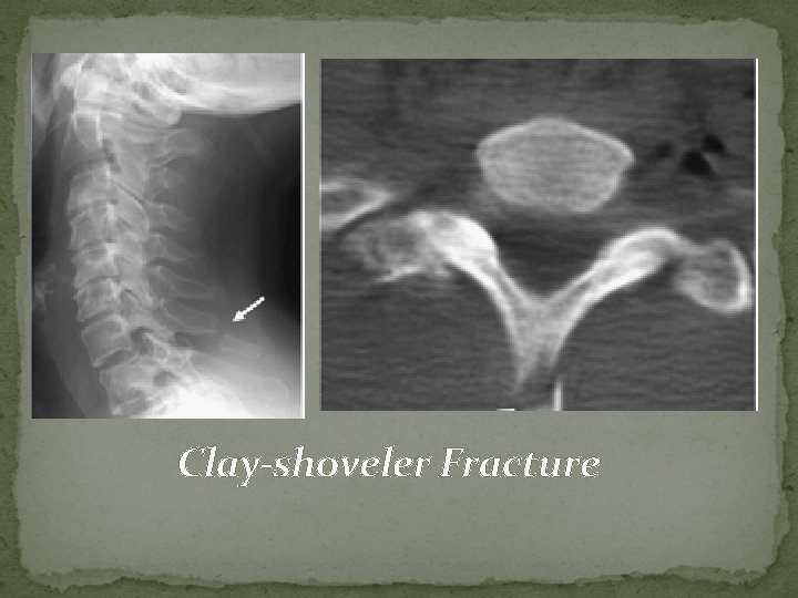 Clay-shoveler Fracture 