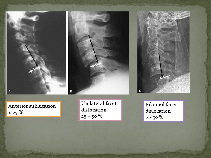 Anterior subluxation < 25 % Unilateral facet dislocation 25 – 50 % Bilateral facet