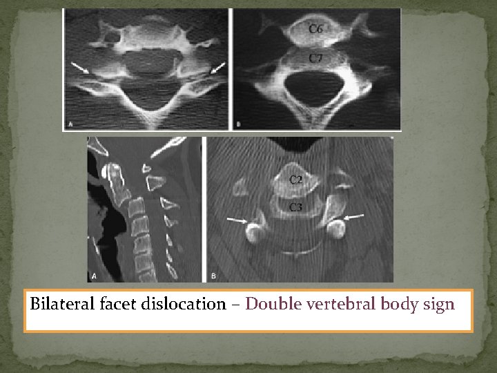 Bilateral facet dislocation – Double vertebral body sign 