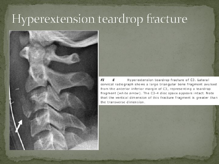 Hyperextension teardrop fracture 