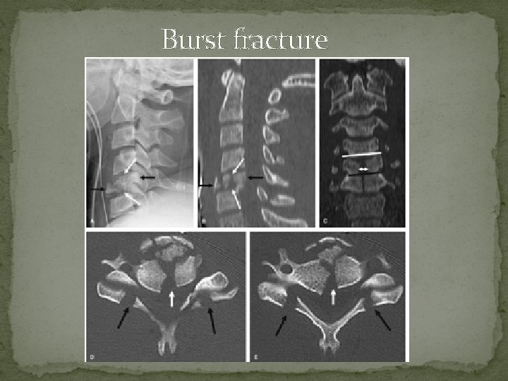 Burst fracture 