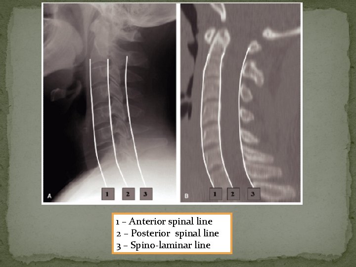 1 – Anterior spinal line 2 – Posterior spinal line 3 – Spino-laminar line