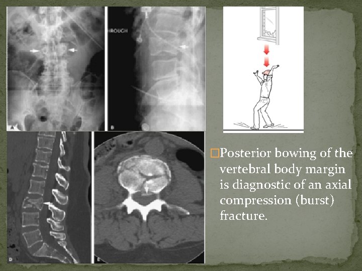 �Posterior bowing of the vertebral body margin is diagnostic of an axial compression (burst)