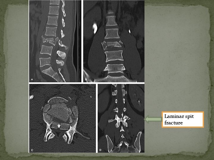 Laminar spit fracture 