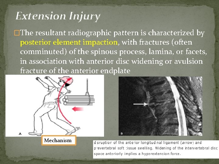 Extension Injury �The resultant radiographic pattern is characterized by posterior element impaction, with fractures