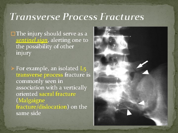 Transverse Process Fractures � The injury should serve as a sentinel sign, alerting one