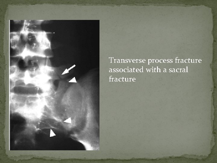 Transverse process fracture associated with a sacral fracture 