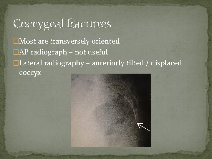 Coccygeal fractures �Most are transversely oriented �AP radiograph – not useful �Lateral radiography –