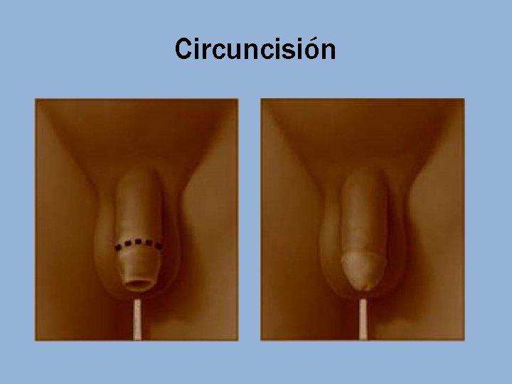 Circuncisión 