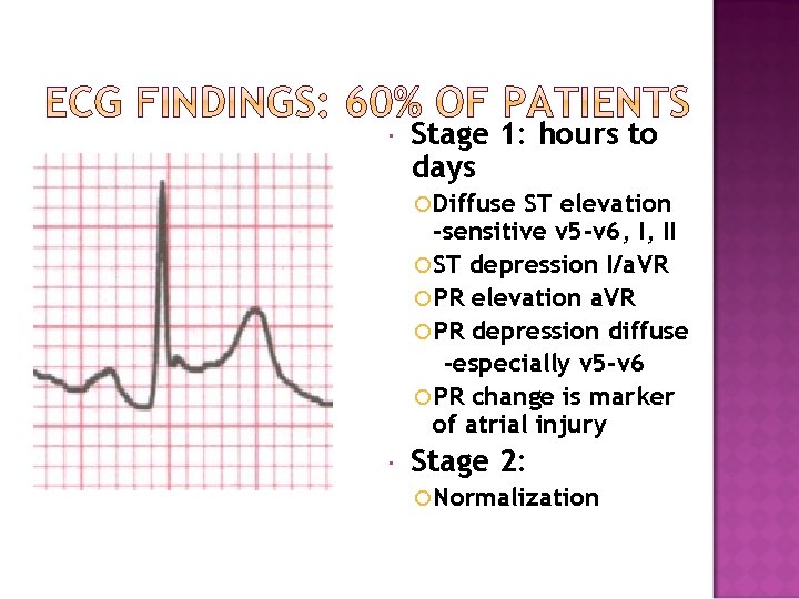  Stage 1: hours to days Diffuse ST elevation -sensitive v 5 -v 6,