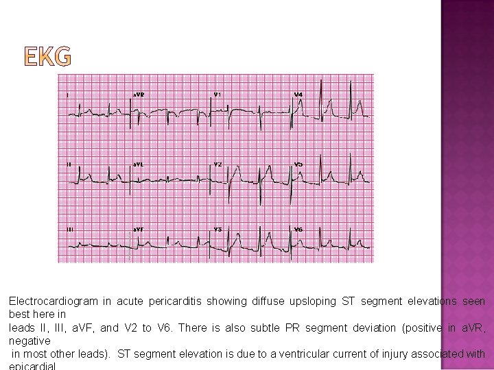 Electrocardiogram in acute pericarditis showing diffuse upsloping ST segment elevations seen best here in