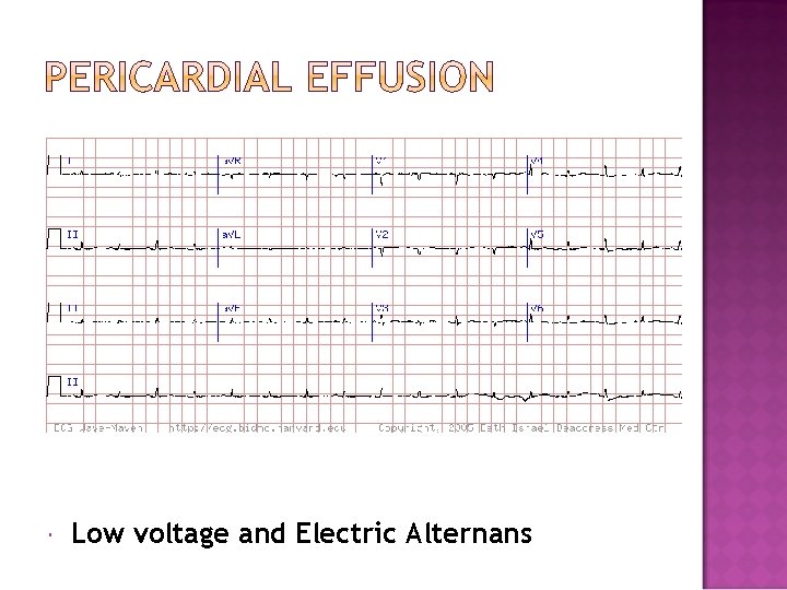  Low voltage and Electric Alternans 