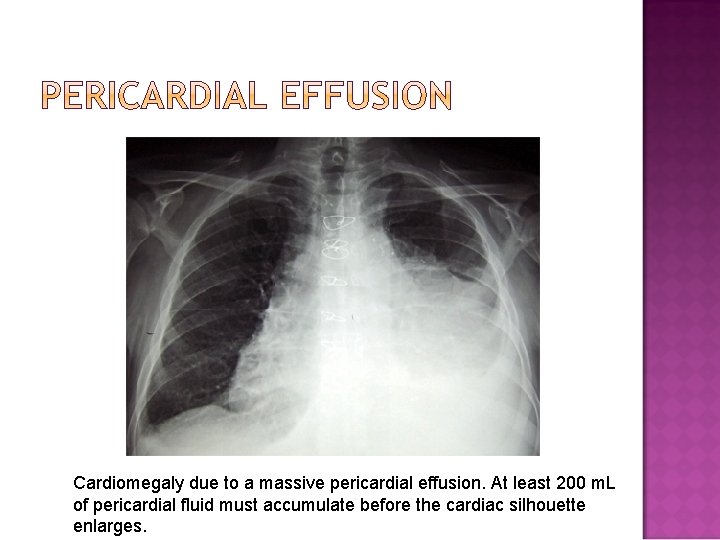 Cardiomegaly due to a massive pericardial effusion. At least 200 m. L of pericardial