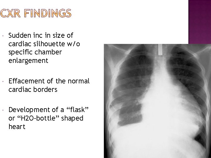  Sudden inc in size of cardiac silhouette w/o specific chamber enlargement Effacement of