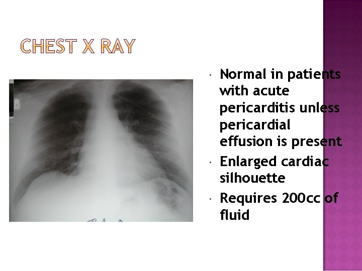  Normal in patients with acute pericarditis unless pericardial effusion is present Enlarged cardiac