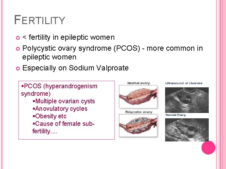 FERTILITY < fertility in epileptic women Polycystic ovary syndrome (PCOS) - more common in