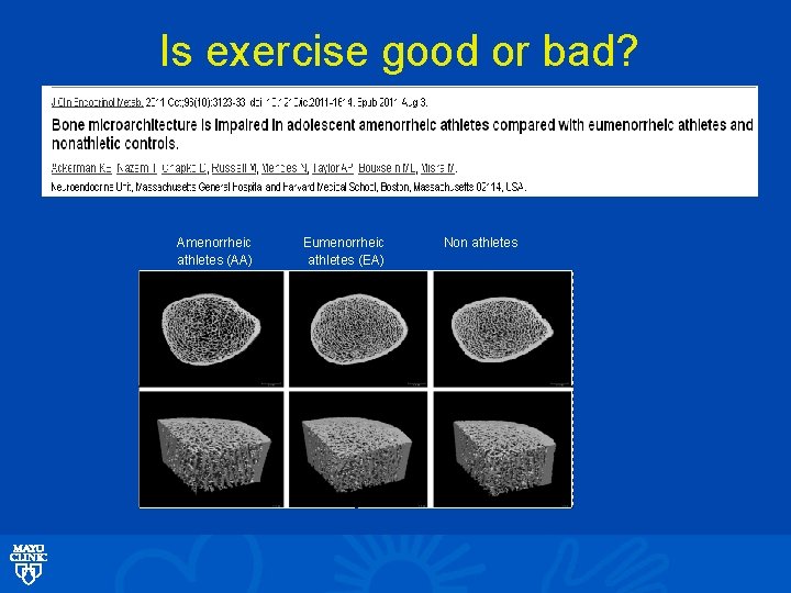 Is exercise good or bad? Amenorrheic athletes (AA) Eumenorrheic athletes (EA) Non athletes 