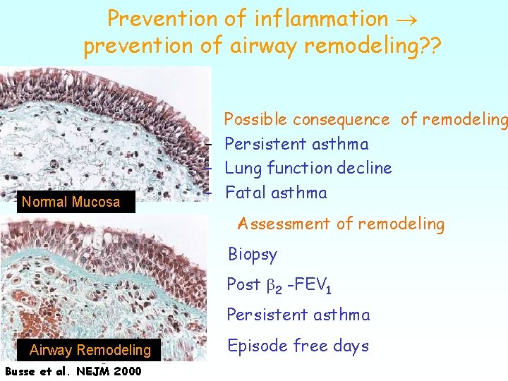 Prevention of inflammation prevention of airway remodeling? ? Normal Mucosa Possible consequence of remodeling