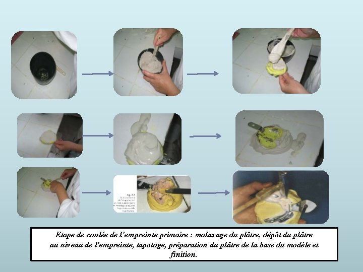 Etape de coulée de l’empreinte primaire : malaxage du plâtre, dépôt du plâtre au