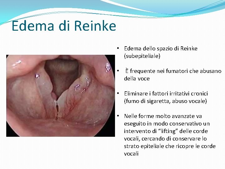 Edema di Reinke • Edema dello spazio di Reinke (subepiteliale) • È frequente nei