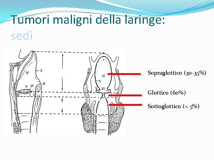 Tumori maligni della laringe: sedi Sopraglottico (30 -35%) Glottico (60%) Sottoglottico (< 5%) 