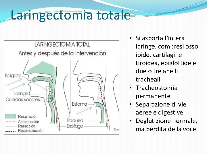 Laringectomia totale • Si asporta l'intera laringe, compresi osso ioide, cartilagine tiroidea, epiglottide e