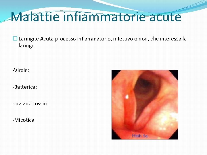 Malattie infiammatorie acute � Laringite Acuta processo infiammatorio, infettivo o non, che interessa la