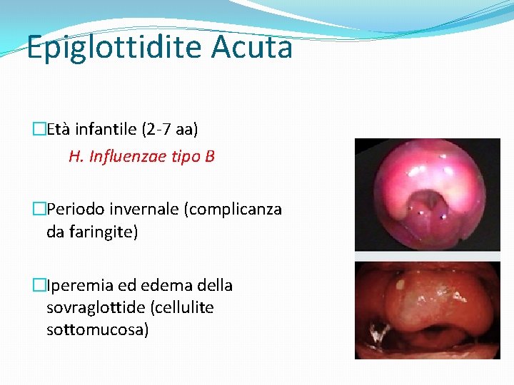 Epiglottidite Acuta �Età infantile (2 -7 aa) H. Influenzae tipo B �Periodo invernale (complicanza