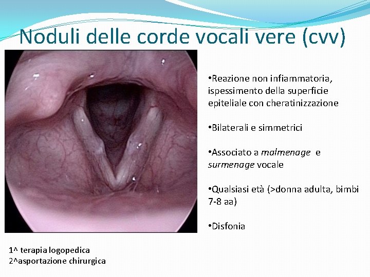 Noduli delle corde vocali vere (cvv) • Reazione non infiammatoria, ispessimento della superficie epiteliale