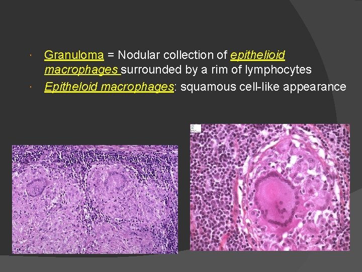 Granuloma = Nodular collection of epithelioid macrophages surrounded by a rim of lymphocytes Epitheloid