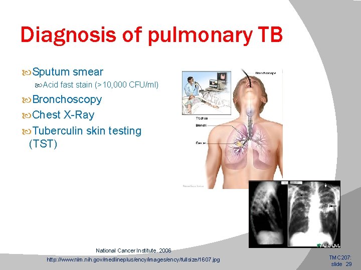 Diagnosis of pulmonary TB Sputum smear Acid fast stain (>10, 000 CFU/ml) Bronchoscopy Chest