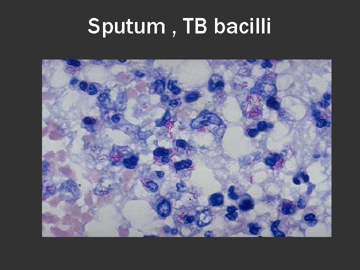 Sputum , TB bacilli 