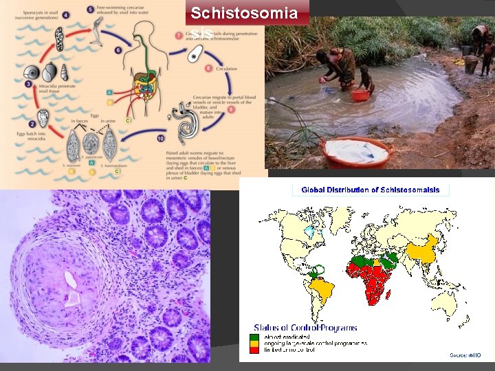 Schistosomia sis 