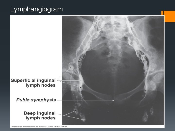 Lymphangiogram 