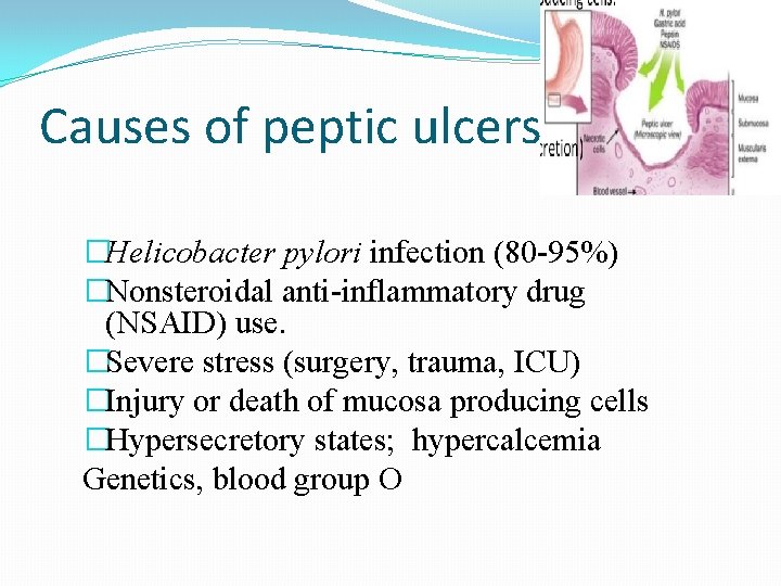 Causes of peptic ulcers �Helicobacter pylori infection (80 -95%) �Nonsteroidal anti-inflammatory drug (NSAID) use.