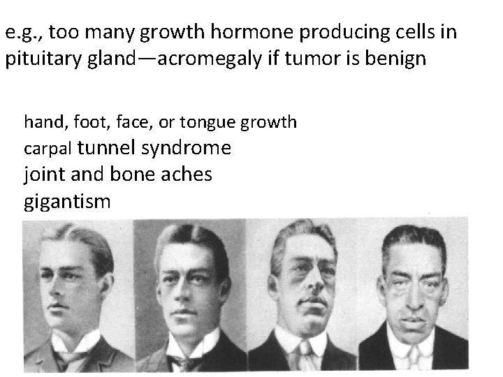e. g. , too many growth hormone producing cells in pituitary gland—acromegaly if tumor e. g. , too many growth hormone producing cells in pituitary gland—acromegaly if tumor