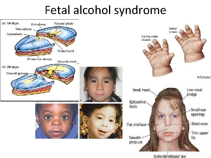 Fetal alcohol syndrome Fetal alcohol syndrome