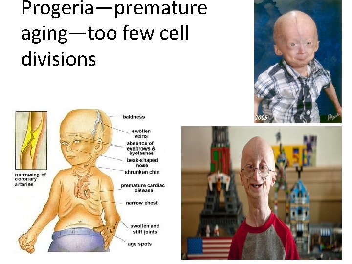 Progeria—premature aging—too few cell divisions Progeria—premature aging—too few cell divisions