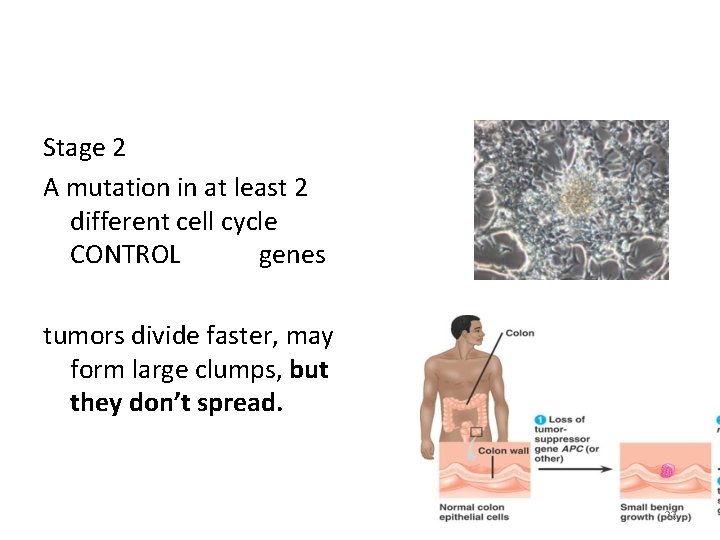 Stage 2 A mutation in at least 2 different cell cycle CONTROL genes tumors Stage 2 A mutation in at least 2 different cell cycle CONTROL genes tumors