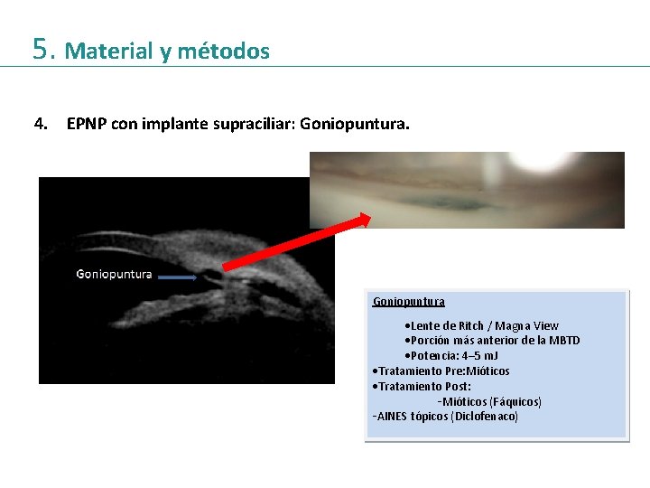 5. Material y métodos 4. EPNP con implante supraciliar: Goniopuntura ·Lente de Ritch /