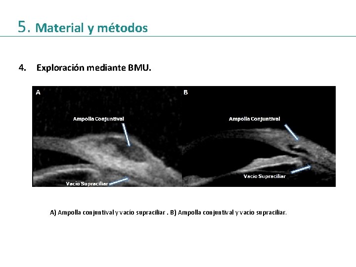 5. Material y métodos 4. Exploración mediante BMU. A) Ampolla conjuntival y vacío supraciliar.