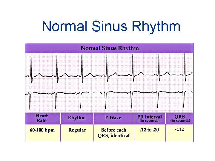 Normal Sinus Rhythm 