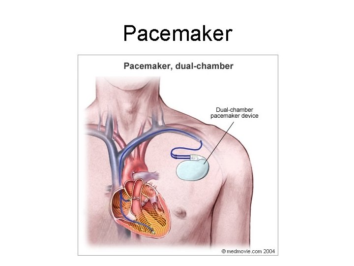 Pacemaker 