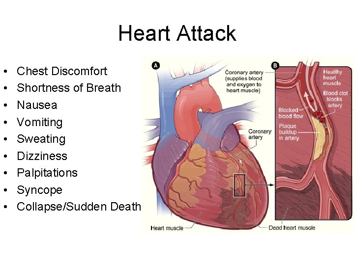 Heart Attack • • • Chest Discomfort Shortness of Breath Nausea Vomiting Sweating Dizziness