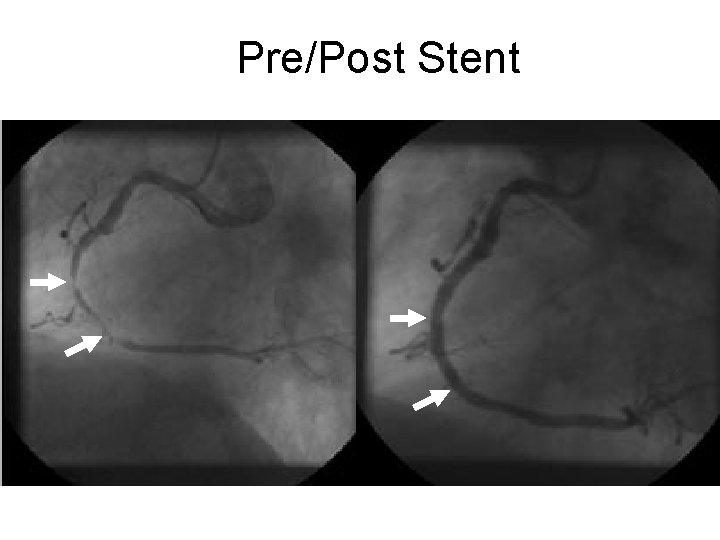 Pre/Post Stent 