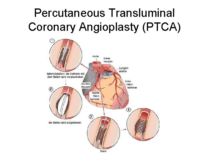 Percutaneous Transluminal Coronary Angioplasty (PTCA) 