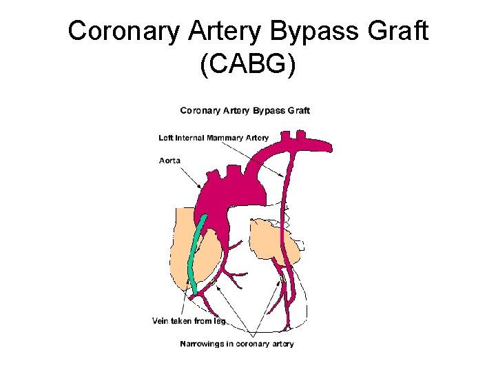 Coronary Artery Bypass Graft (CABG) 