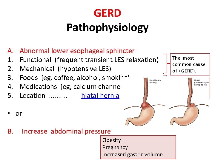 GERD Pathophysiology A. 1. 2. 3. 4. 5. Abnormal lower esophageal sphincter Functional (frequent