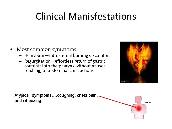 Clinical Manisfestations • Most common symptoms – Heartburn—retrosternal burning discomfort – Regurgitation—effortless return of