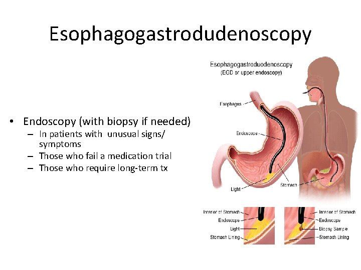 Esophagogastrodudenoscopy • Endoscopy (with biopsy if needed) – In patients with unusual signs/ symptoms